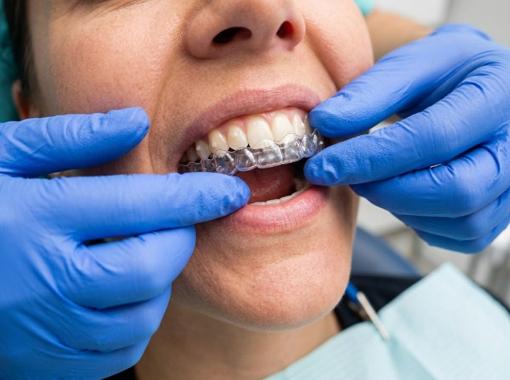 Invisalign for Adults in Hyderabad