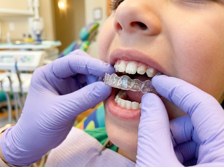Invisalign First for Crooked, Crowded Teeth & Bite Problems in Kids