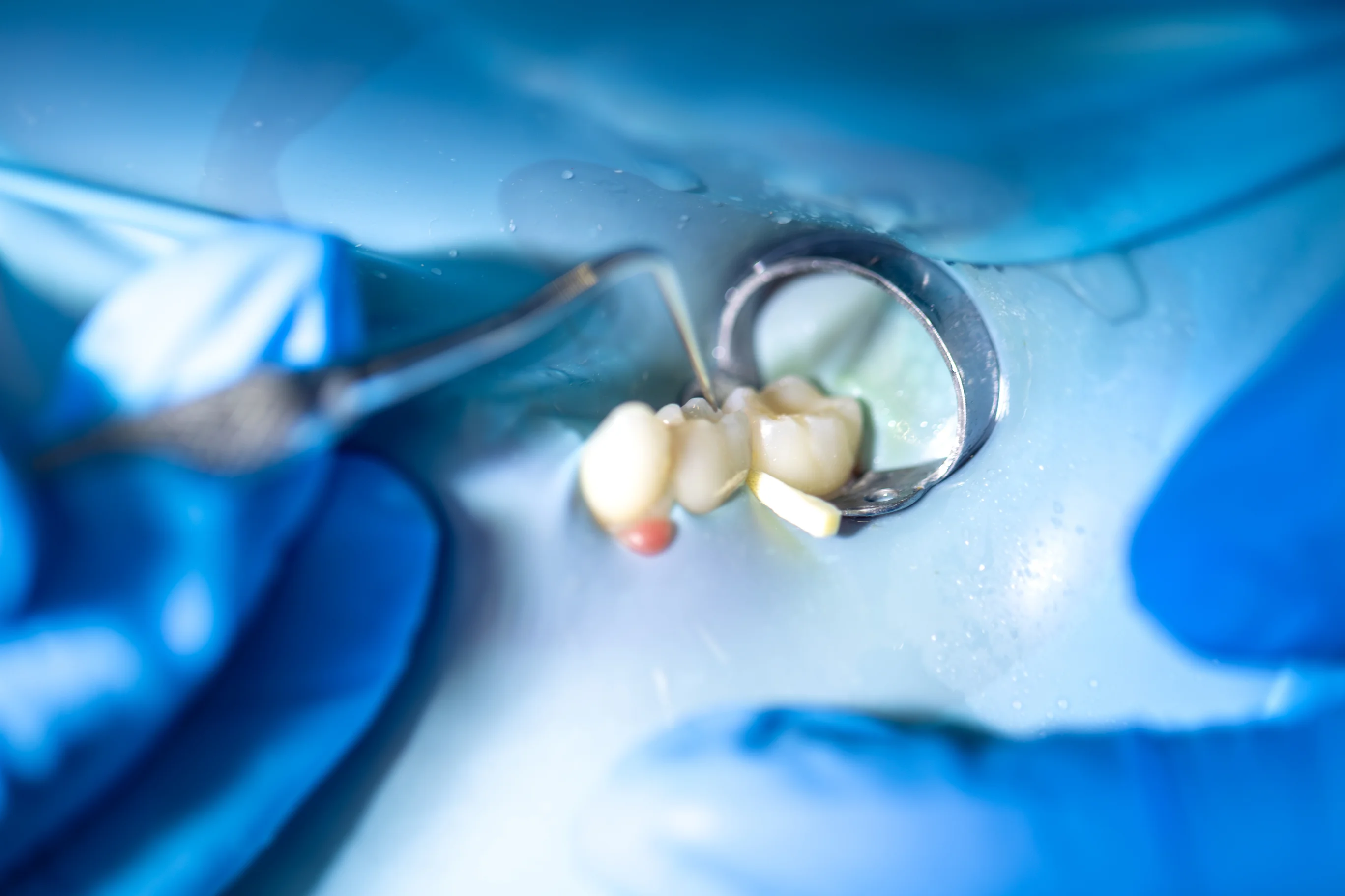 Wisdom Tooth Extraction